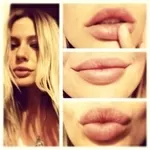 Контурная пластика лица,  увеличение губ,  увеличение скул,  коррекция формы