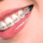 Брекет-системы, керамические брекеты по акции (5000 грн)