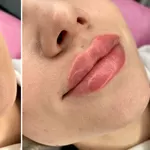 Професійна контурна пластика губ - омолодження і збільшення об'єму губ