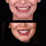 Надійні вініри у місті Київ - стоматологічна клініка Са-Ната