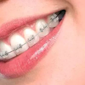 Брекет-системы,  керамические брекеты по акции (5000 грн)