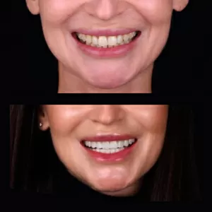 Надійні вініри у місті Київ - стоматологічна клініка Са-Ната