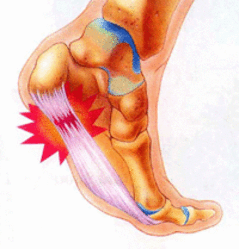 Пластырь для лечения пяточной шпоры (Bone Spur Plaster) 2