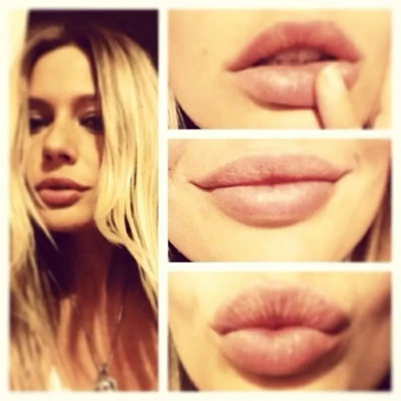 Контурная пластика лица, увеличение губ, увеличение скул, коррекция формы