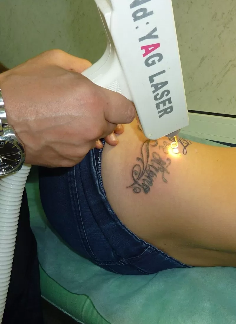 Удаление Тату и Перманентного Татуажа в Киеве на Позняках 2