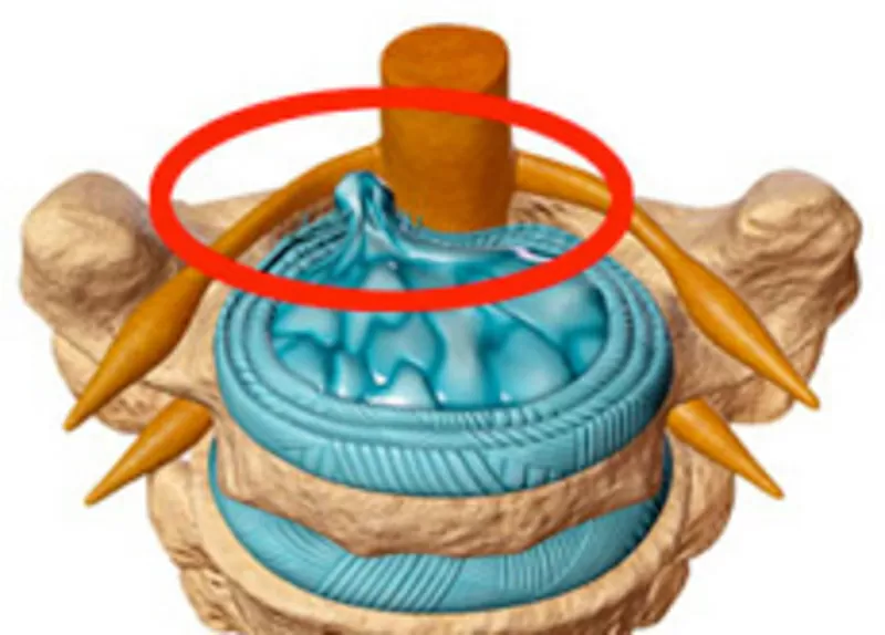 Лечение межпозвоночной грыжи без операции