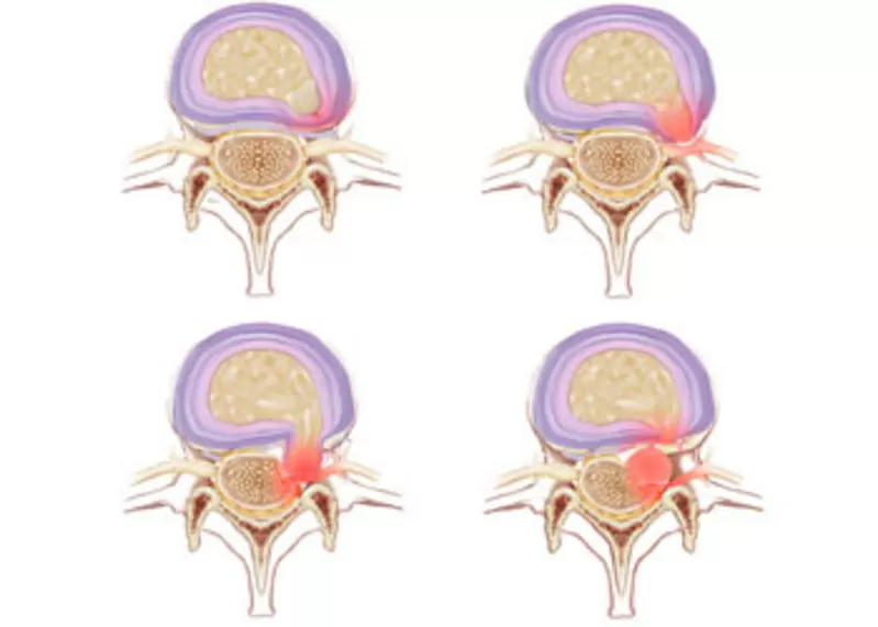 Лечение межпозвоночной грыжи без операции 3