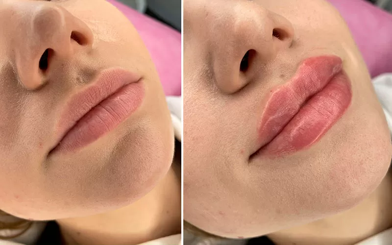 Професійна контурна пластика губ - омолодження і збільшення об'єму губ