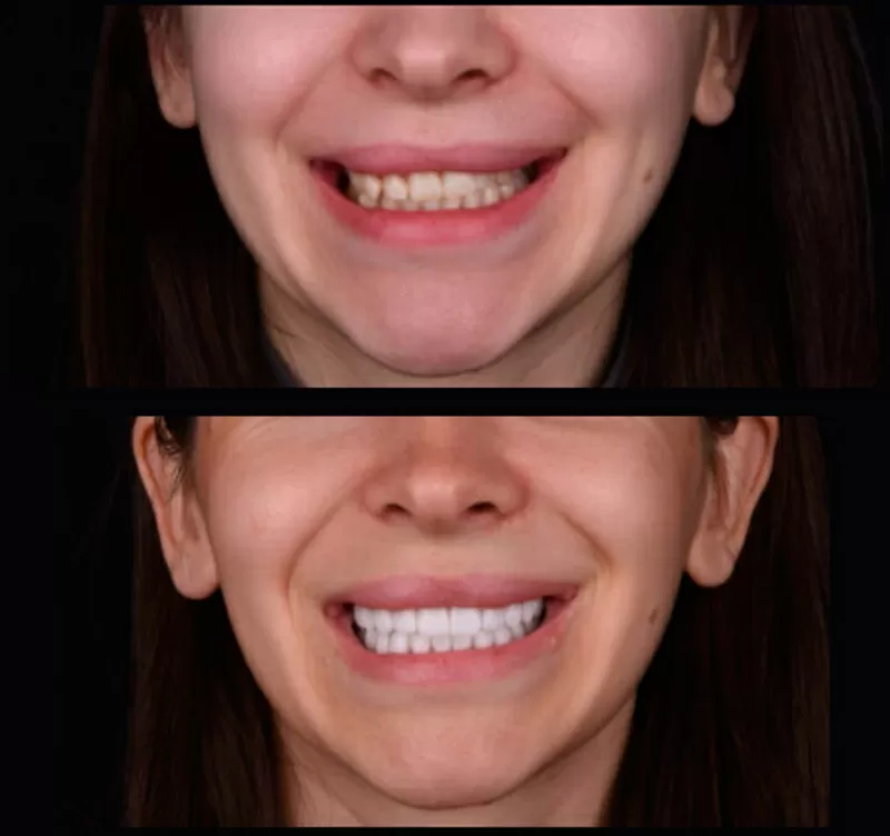 Надійні вініри у місті Київ - стоматологічна клініка Са-Ната 2