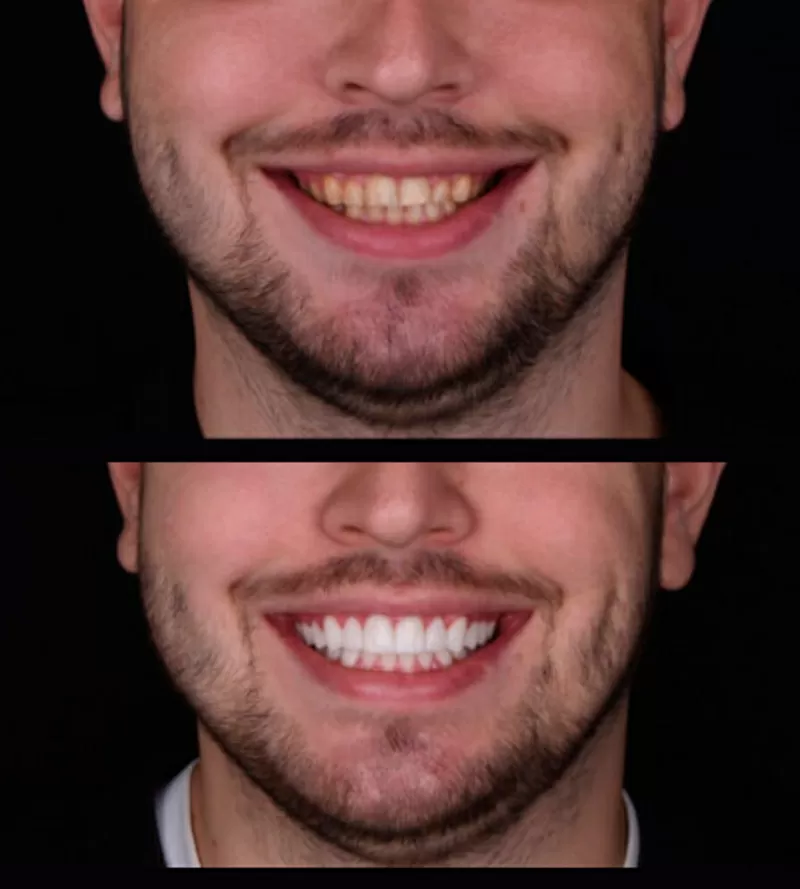 Надійні вініри у місті Київ - стоматологічна клініка Са-Ната 3