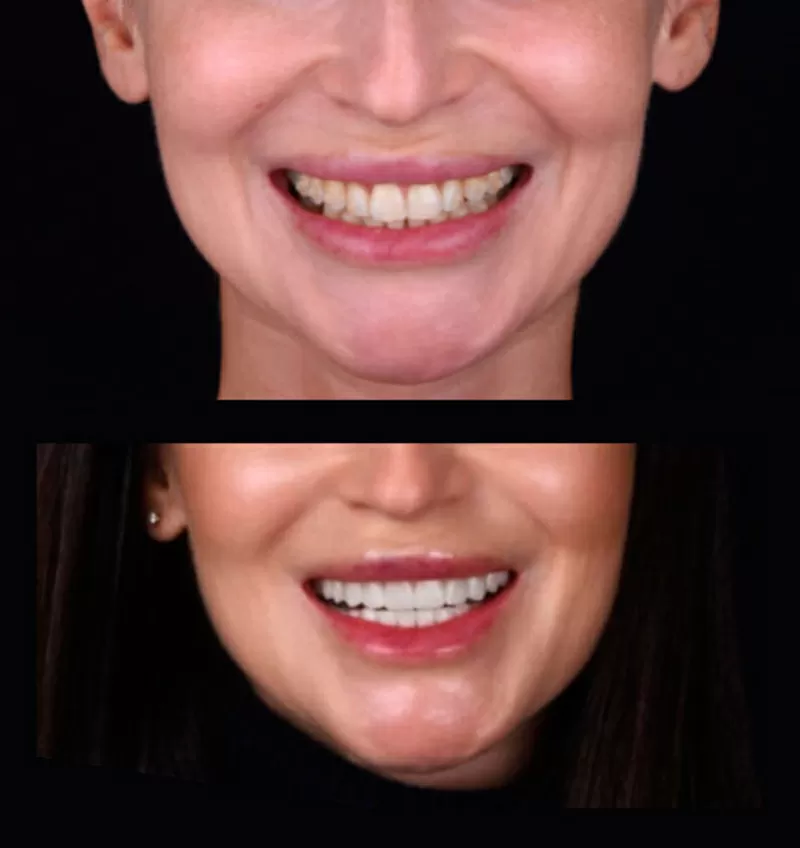 Надійні вініри у місті Київ - стоматологічна клініка Са-Ната